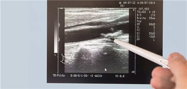 Bei subklinischer Hypothyreose auf die Gefäße schauen Ultraschallbild einer Halsschlagader (Arteria carotis communis) mit großem Kalkplaque.