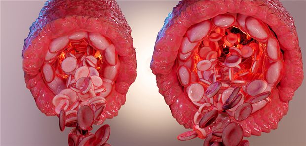 Um Menschen mit der seltenen Takayasu-Arteriitis zu behandeln, bedarf es weiterer Therapien. Zwei neue Studien beschäftigen sich mit solchen alternativen Behandlungsstrategien. Die Erste explorierte die Behandlung mit einem konventionellen synthetischen krankheitsmodifizierenden Antirheumatika und einem Tumornekrosefaktor-a-Inhibitoren und die Zweite die Behandlung mit einem Januskinase-Inhibitor.