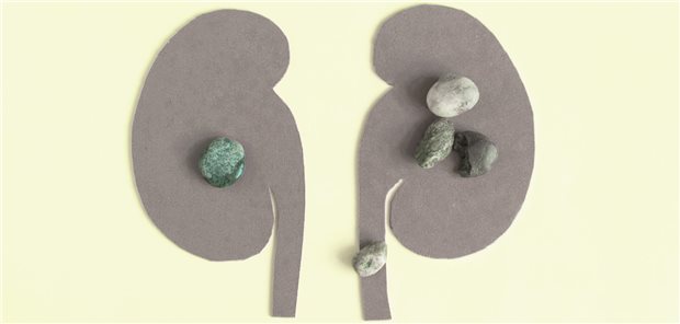 Schematische Darstellung der Niere mit Nierensteinen. 