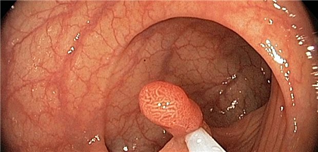 Darmpolyp
