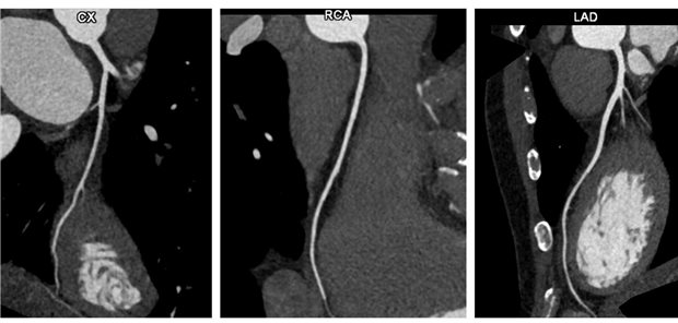 Herz-CT