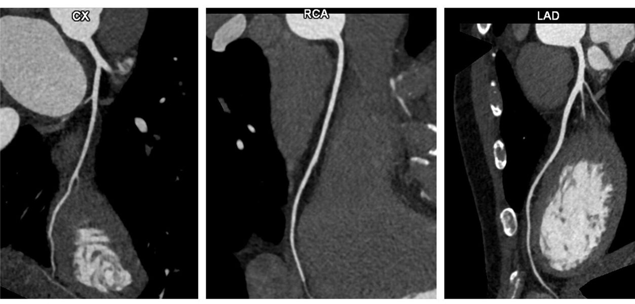 Women’s Kardio-CT Outcomes: Worse Prognosis Despite Similar Results?