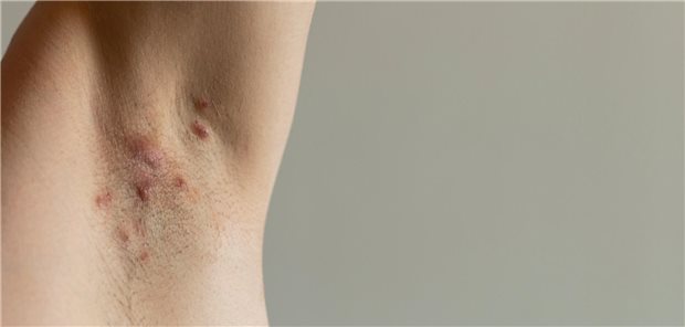 Unangenehm bis schmerzhaft: Entzündete Haarfollikel bei Akne inversa. In leichten bis mittelschweren Fällen soll  eine Bestrahlung – zusätzlich zu antibiotischen Salben – wirklich was bringen.