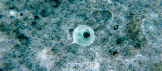 Entamoeba histolytica: einzelliger Zeitzünder in der Leber Unbehandelt kann Entamoeba histolytica zu Zysten und Leber-Abszessen führen.