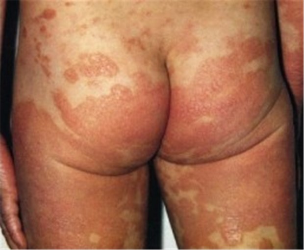 Etanercept bei Kindern mit Psoriasis erfolgreich Ungefähr eines von hundert Kindern in Deutschland ist an Psoriasis erkrankt.