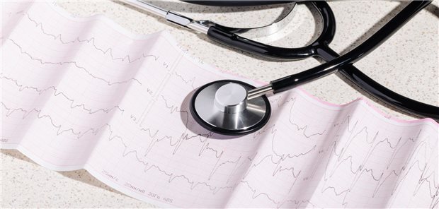 Das Kardiogramm eines Patienten mit abnormalen Herzrhythmus, das auf Vorhofflimmern hindeutet.