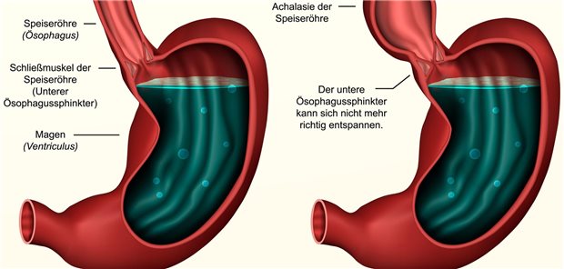 Medizinische Illustration die einen gesunden Magen mit einem Magen mit Achalsie der Speiseröhre gegenüberstellt.