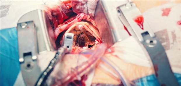 „Unsere Studie zeigt, dass auch bei einer obstruktiven KHK mit sehr hohem Risiko keine PCI vor der TAVI erforderlich ist, um das Risiko während des Klappenersatzes zu senken“, lautet das Fazit der Studienautoren. (Symbolbild)
