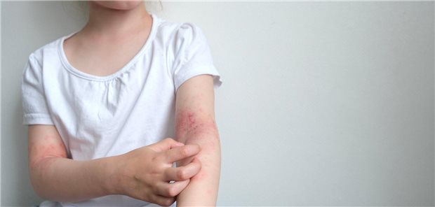 Das Kind mit atopischer Dermatitis kratzt sich an der entzündeten Haut in der Armbeuge.