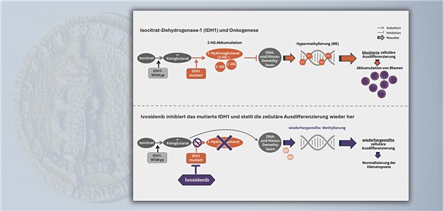 Unter Ivosidenib normalisiert sich die Hämatopoese bei Erkrankten mit akuter myeloischer Leukämie und einer IDH1-Mutation, indem der Wirkstoff die Akkumulation von 2-HG inhibiert. 