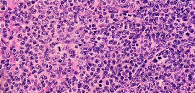 Unter dem Mikroskop: Hochgradiges follikuläres Lymphom mit Randzonendifferenzierung. Mehrere Lymphozyten durchlaufen eine Mitose.  Lisa/stock.adobe.com