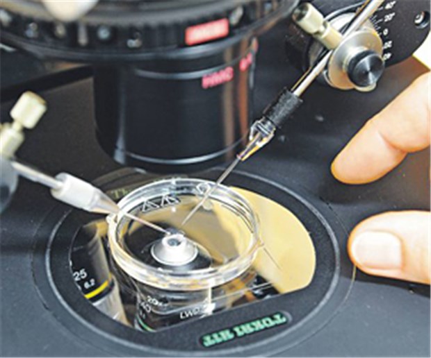 Brustkrebs durch IvF in jungen Jahren? Unter dem Mikroskop werden Spermien in Eizellen injiziert. Wird das Wunschkind mit einem erhöhten Krankheitsrisiko erkauft?