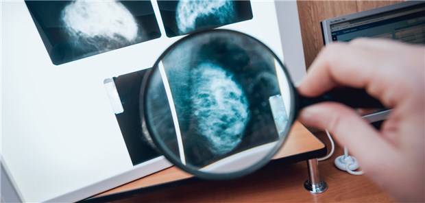 Unter der Lupe: „Jede betroffene Frau hat ihren individuellen Brustkrebs.“