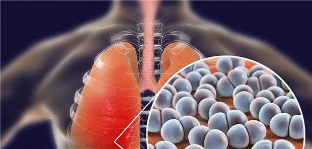 Untere Atemwegsinfektion: Streptococcus pneumoniae in der Lunge. 