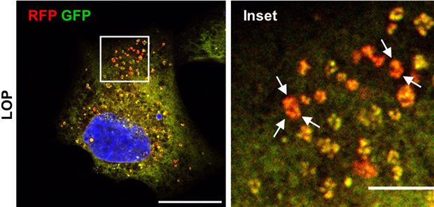 Unterm Mikroskop: In unbehandelten Glioblastomzellen ist das Endoplasmatische Retikulum gelb gefärbt. Ist es unter Einfluss von Loperamid degradiert, leuchtet es rot (Pfeile).