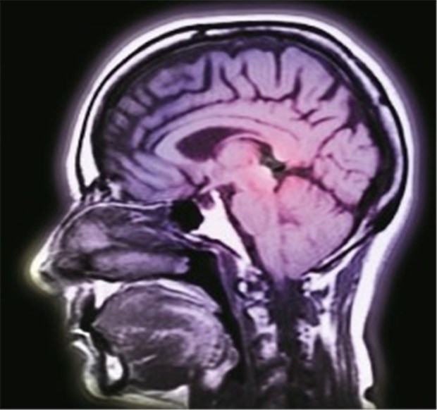 Unipolar oder bipolar depressiv? Die Bildgebung nützt hier wenig Unterschiede zwischen uni- und bipolar erkrankten Depressiven lassen sich per MRT kaum finden.