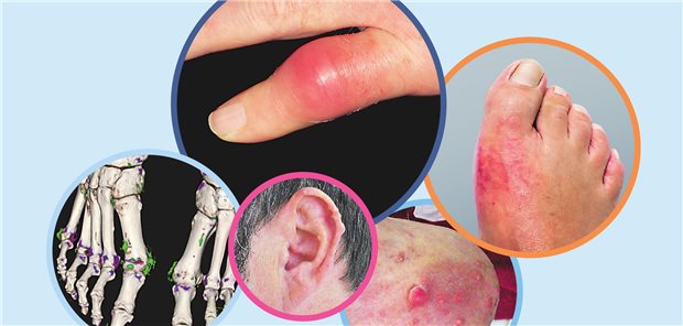 Unterschiedliche Erscheinungen der Gicht