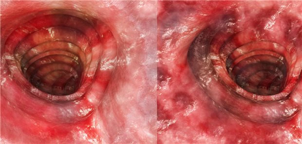 Unterschiedliche Stadien einer Colitis ulcerosa im endoskopischen Befund.