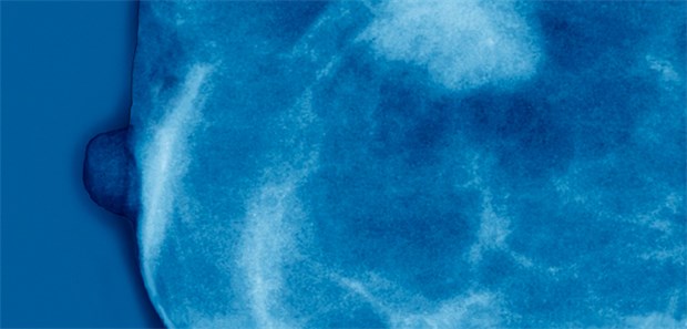 Immunzellen sagen Heilungschancen bei Brustkrebs voraus Unterstützung bei der Therapieentscheidung: Immunzellen helfen bei der Prognose-Einschätzung für Brustkrebspatientinnen.