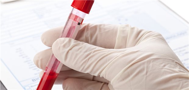 Untersuchung des Blutbildes: Täglich werden 1010-1012 neue Blutzellen gebildet. Mutationen sind da unvermeidbar.