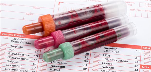 Reagenzglas mit Blutprobe für Lipoprotein(a)-Test zur Bewertung des kardiovaskulären Risikos.