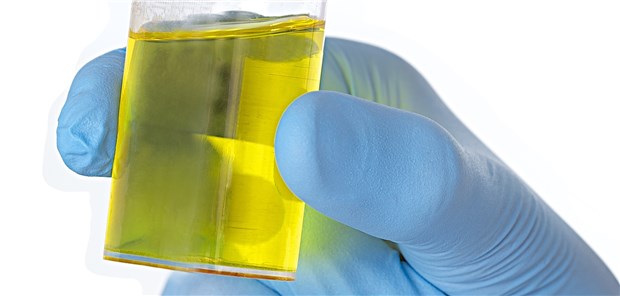 Urinprobe: Spezielle Genmuster sollen anzeigen, ob ein aggressiver Prostatakrebs vorliegt.