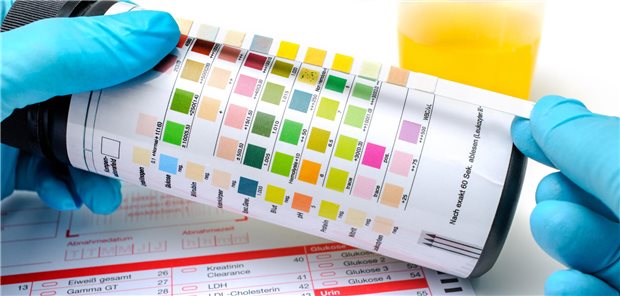 Eine Urinprobe wird auf die Farbe untersucht.