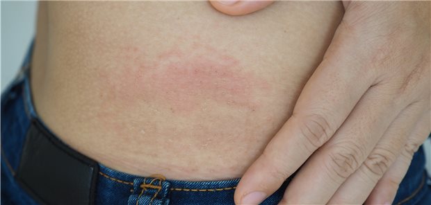 Urtikaria: Reaktion, die direkt nach einer Insulininjektion auftreten kann.