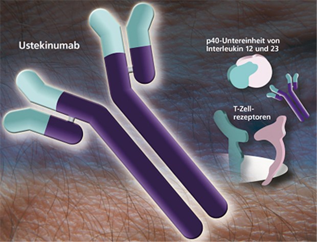 Ustekinumab bindet an die p40-Untereinheit, einen Bestandteil der Interleukine 12 und 23. Dadurch wird der Entzündungsprozess spezifisch gestoppt und die übermäßige Produktion von Hautzellen normalisiert.