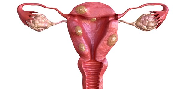 Uterusmyome: Mithilfe der Radiofrequenzablation werden diese verödet. Eine spezielle Methode dazu hat das Institut für Qualität und Wirtschaftlichkeit im Gesundheitswesen bewertet.