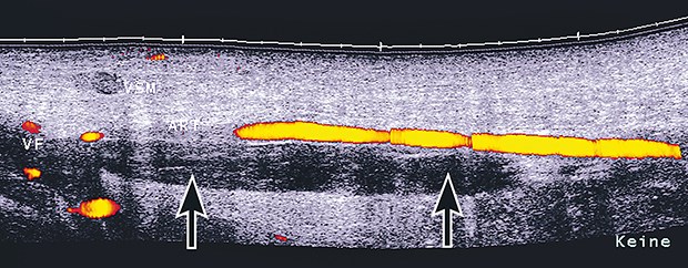 V. femoralis mit Thrombose (Pfeile) im Sonogramm.