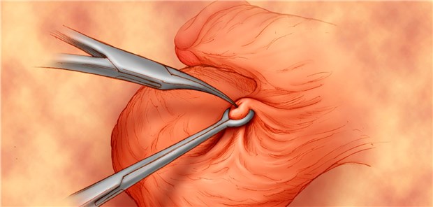 Vasektomie: Die Assoziation mit einem erhöhten Risiko für Prostatakrebs wurde erneut belegt.