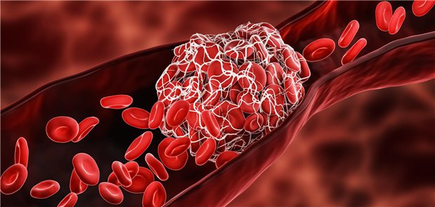 Dreidimensionale gerenderte Illustration eines Blutgerinnsel oder Thrombus, der den Fluss der roten Blutkörperchen in einer Arterie oder Vene blockiert. 
