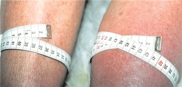 Venenthrombose im linken Bein: Hospitalisierte COVID-19-Patienten haben ein besonders hohes Risiko für eine solche Komplikation.