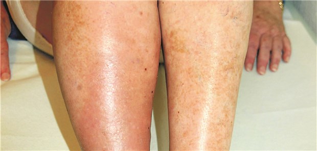 Venenthrombose im rechten Bein.