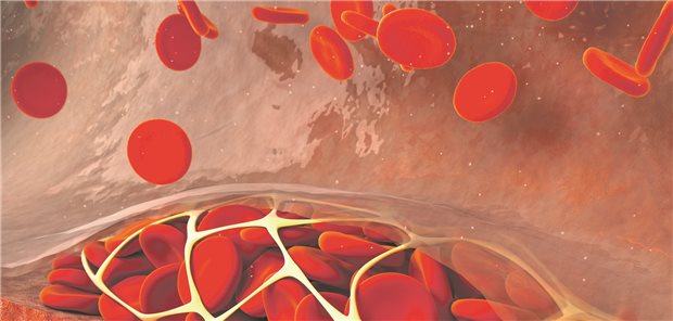 Venöse Thromboembolie: Krebspatienten mit VTE sind ein besonders schwierig zu managendes Kollektiv.