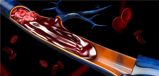 Venöse Thrombose: Patienten mit Psoriasis sind überdurchschnittlich häufig davon betroffen.