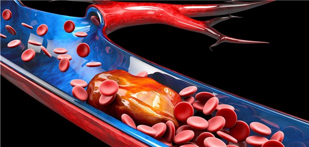Venösen Thromboembolien lässt sich offenbar auch gut mit dem Faktor XIa-Hemmer Milvexian vorbeugen.