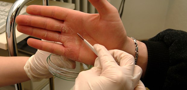 Hohe Kosten durch Handekzeme Verdacht auf Handekzem. Bei der Diagnostik sollten mögliche Pilzinfektionen ausgeschlossen werden.