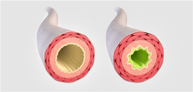 Das leisten Fixkombinationen bei Asthma Verengte Atemwege bei Asthma mit entzündlich bedingten Schleimhautveränderungen.
