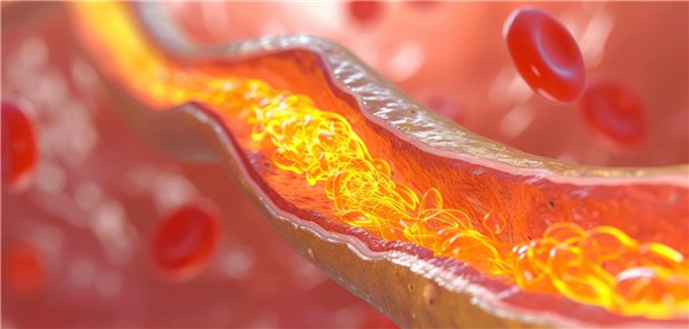 Verengte Koronararterie: Ein Paclitaxel-beschichteter Ballon könnte insbesondere Betroffenen mit Stent-Restenose helfen, denen bereits mehrere Stents in die Zielläsion eingesetzt wurden. Denn hier würden zusätzliche Stents das Lumen weiter verringern und die therapeutischen Optionen limitieren. 