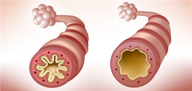 Verengter Bronchus (links) als typisches Zeichen bei Asthma und zum Vergleich ein gesunder Bronchus (rechts).