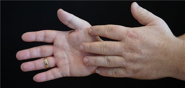 Vergrößerte Extremitäten: Wenn plötzlich die Ringe und die Schuhe nicht mehr passen, sich ungewöhnliche Lücken zwischen den Zähnen gebildet haben und eine Makroglossie sowie Gelenks- und Knochenschmerzen bestehen, liegt womöglich eine Akromegalie vor.