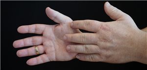 Seltene Ursachen von Hyperglykämien oft ausgeblendet