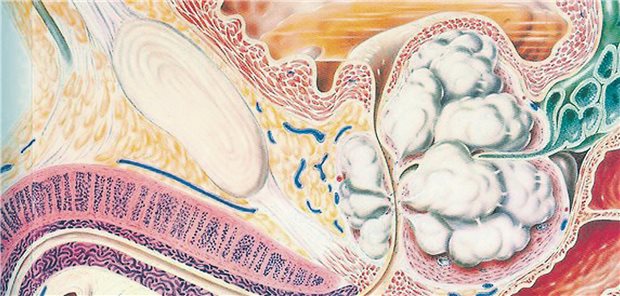 Vergrößerte Prostata: In Deutschland entwickelt jeder zweite bis dritte Mann über 50 Jahren eine BPH.