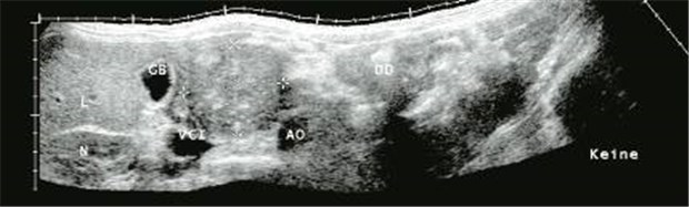 Chronische Pankreatitis - beste Therapie erfolgt interdisziplinär Vergrößerter Pankreaskopf bei chronischer Pankreatitis im Ultraschall (zwischen den Markern). In der Umgebung sind Leber (L), Niere (N), Gallenblase (GB), Vena cava inferior (VCI), Aorta (AO) und Dünndarm (DD) sichtbar.