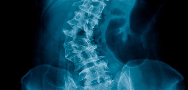 Verkrümmte Wirbelsäule im Röntgenbild: Die anatomischen Veränderungen bei Skoliose scheinen auch die Herzfunktion zu beeinträchtigen, berichten britische Forscher.