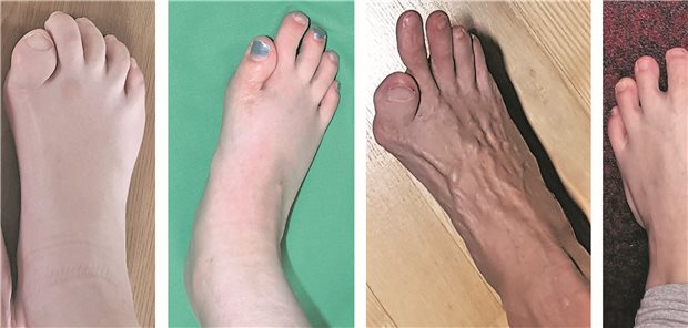 Verkürzung und Fehlstellung der großen Zehen nach lateral von Geburt an ist ein typisches Merkmal der FOP. 