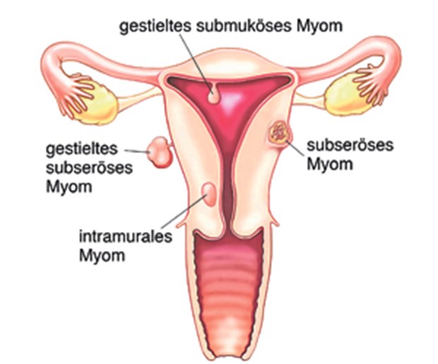 Macht Embolisation der Uterusarterien unfruchtbar? Verschiedene Arten von Myomen.
