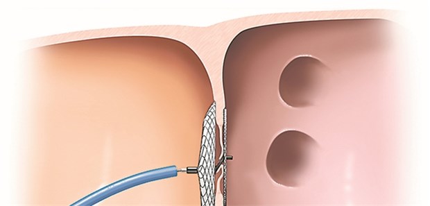 Verschluss eines offenen Foramen ovale mit einem Okkluder-System.